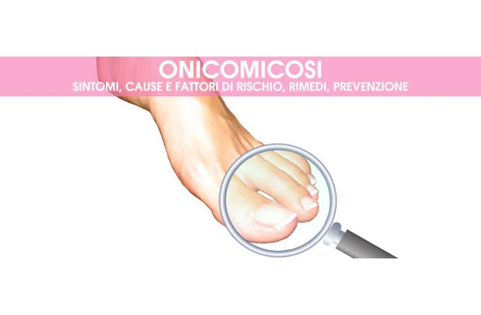 Onicomicosi: Guida Completa alla Prevenzione e al Trattamento