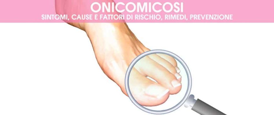 Onicomicosi: Guida Completa alla Prevenzione e al Trattamento